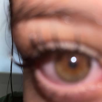 Yanlış Kirpik Uygulaması Sonrası Gözlerimde Şiddetli Yanma Ve Batma