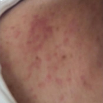 Bingo Matik Deterjan Sonrası Ailecek Yaşanan Ciddi Alerjik Reaksiyonlar