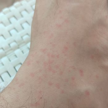 Bingo Matik Deterjan Sonrası Ailecek Yaşanan Ciddi Alerjik Reaksiyonlar