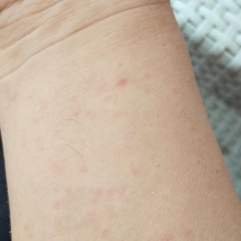 Bingo Matik Deterjan Sonrası Ailecek Yaşanan Ciddi Alerjik Reaksiyonlar