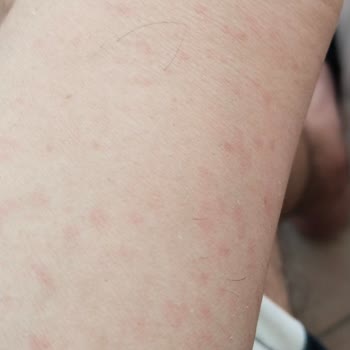 Bingo Matik Deterjan Sonrası Ailecek Yaşanan Ciddi Alerjik Reaksiyonlar