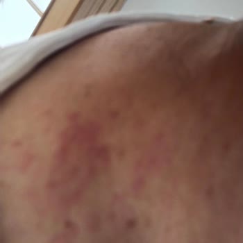 Bingo Matik Deterjan Sonrası Ailecek Yaşanan Ciddi Alerjik Reaksiyonlar