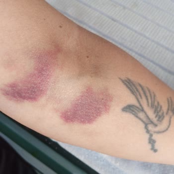 Kan Alma İşleminde Yaşanan Sorun Ve Hemşirelerin Denetimi