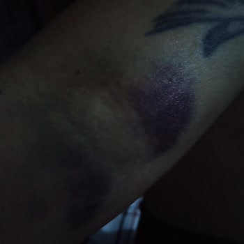 Kan Alma İşleminde Yaşanan Sorun Ve Hemşirelerin Denetimi