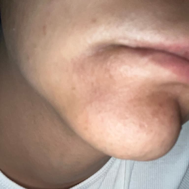 Garnier C Vitamini Serum Sonrası Ciltte Yanık Ve Lekeler Oluştu