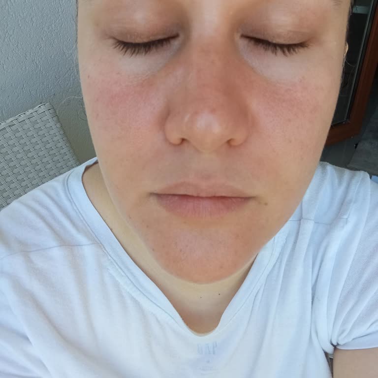 Yüz Yıkama Jelinin Ciltte Yanma Ve Tahrişe Sebep Olması