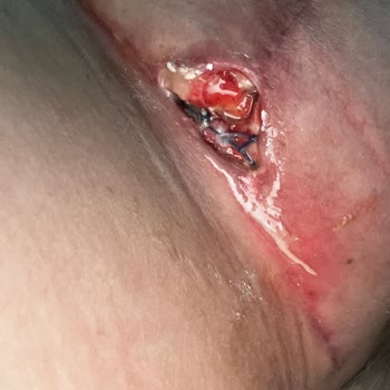 Meme Estetiği Ameliyatında Yaşadığım Olumsuz Deneyim Ve Sonrası