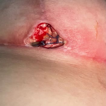 Meme Estetiği Ameliyatında Yaşadığım Olumsuz Deneyim Ve Sonrası