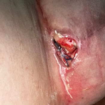 Meme Estetiği Ameliyatında Yaşadığım Olumsuz Deneyim Ve Sonrası