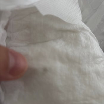 Bebek Bezinde Beklenmedik Yabancı Madde Şoku