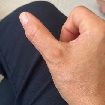 Dyson Süpürge Kullanımı Elimde Kalıcı Hasara Yol Açtı