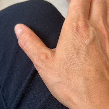 Dyson Süpürge Kullanımı Elimde Kalıcı Hasara Yol Açtı