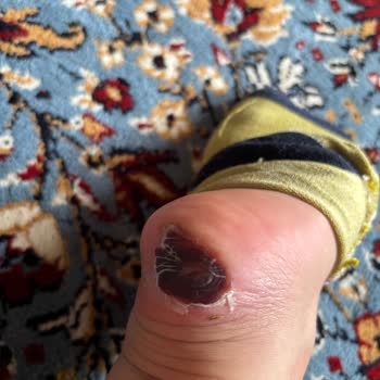 Alçı Sonrası Oluşan Yarada Hastane Sorumluluğu Kabul Etmedi