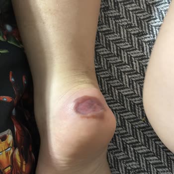 Alçı Sonrası Oluşan Yarada Hastane Sorumluluğu Kabul Etmedi