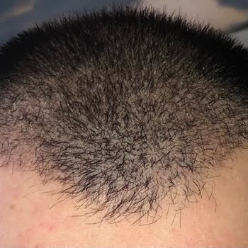 Prof. Dr. Derya Özçelik Saç Ekimi Sonrası Hayal Kırıklığı Ve Başarısız Sonuç