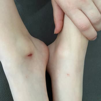 Ayakkabı Kullanımı Sonrası Kızımın Ayağında Yaralar Oluştu