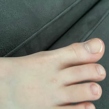 Ayakkabı Kullanımı Sonrası Kızımın Ayağında Yaralar Oluştu