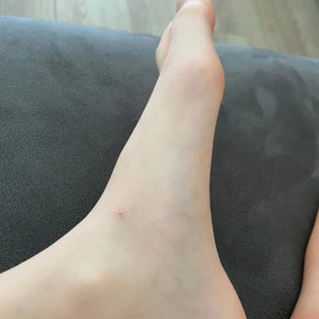 Ayakkabı Kullanımı Sonrası Kızımın Ayağında Yaralar Oluştu