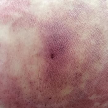 Süleyman Yalçın Şehir Hastanesi Acil Serviste Yanlış İğne ve İlgisizlik Sonrası Artan Sorunlar