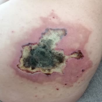 Süleyman Yalçın Şehir Hastanesi Acil Serviste Yanlış İğne ve İlgisizlik Sonrası Artan Sorunlar