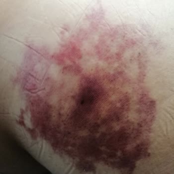 Süleyman Yalçın Şehir Hastanesi Acil Serviste Yanlış İğne ve İlgisizlik Sonrası Artan Sorunlar