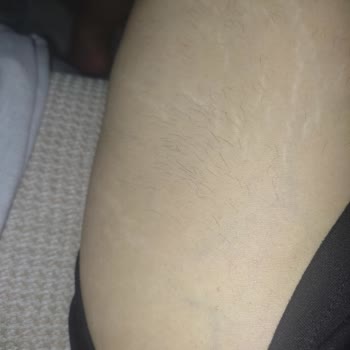 Medica Derma Alexandrite Lazer Sonrası Tüylerim Kalınlaştı Ve Mağduriyetim Giderilmedi