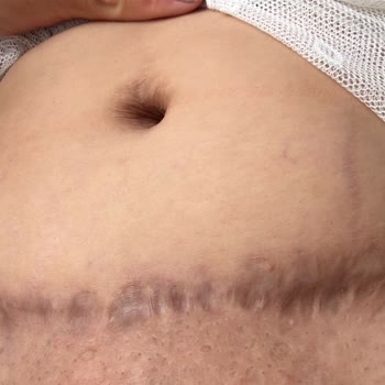 Ameliyat Sonrası Hayal Kırıklığı Ve Yetersiz İlgi