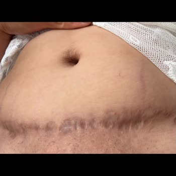 Ameliyat Sonrası Hayal Kırıklığı Ve Yetersiz İlgi