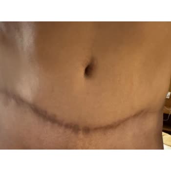 Ameliyat Sonrası Hayal Kırıklığı Ve Yetersiz İlgi