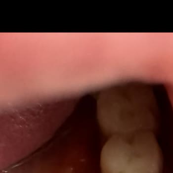 Diş Kaplamamda Sürekli Sorun Yaşıyorum Yardım Bekliyorum