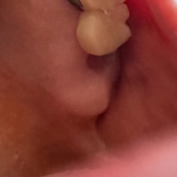 Diş Kaplamamda Sürekli Sorun Yaşıyorum Yardım Bekliyorum