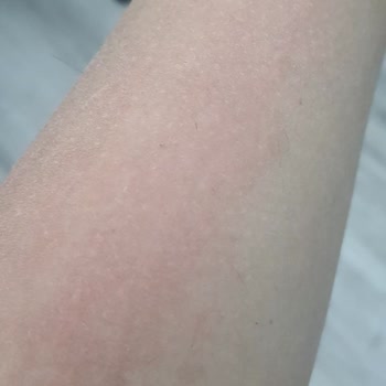 I Face Skin Burns and Irritation from Mustela Family Sunscreen SPF