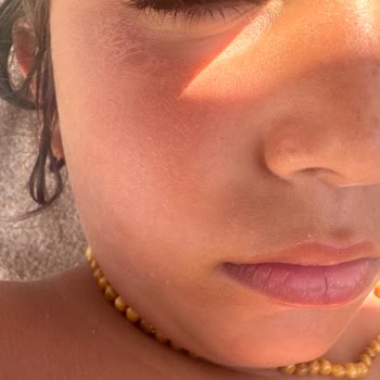 I Face Severe Skin Peeling on My Child from Mustela Sunscreen
