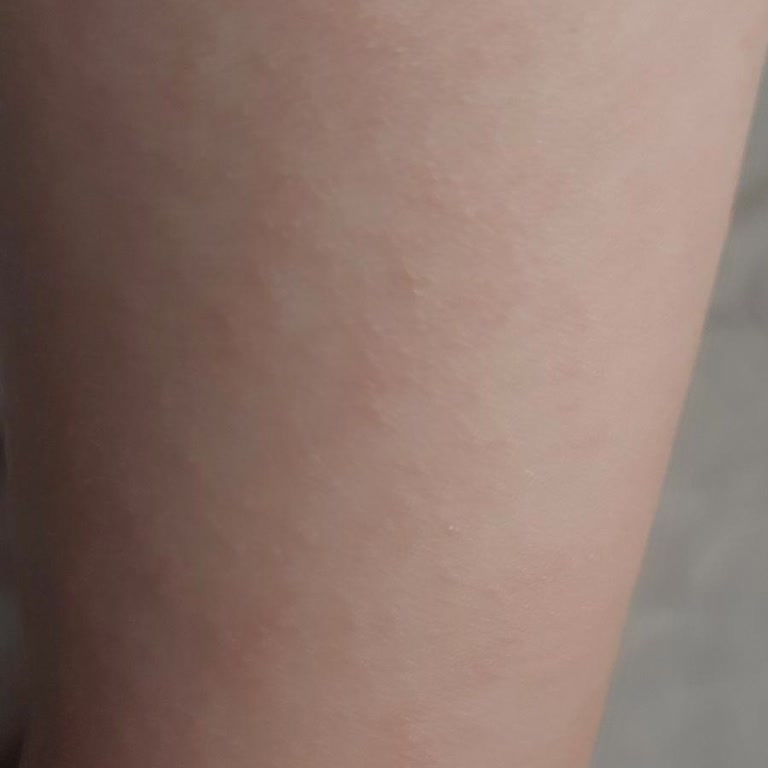 I Face Allergy Reaction on My Baby After Using Mustela Cream