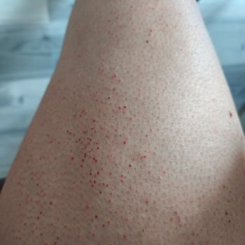 Ürün Yanma Ve Tahrişe Sebep Oldu, Şiddetle Uzak Durulmalı