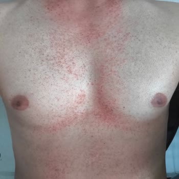 Ürün Yanma Ve Tahrişe Sebep Oldu, Şiddetle Uzak Durulmalı