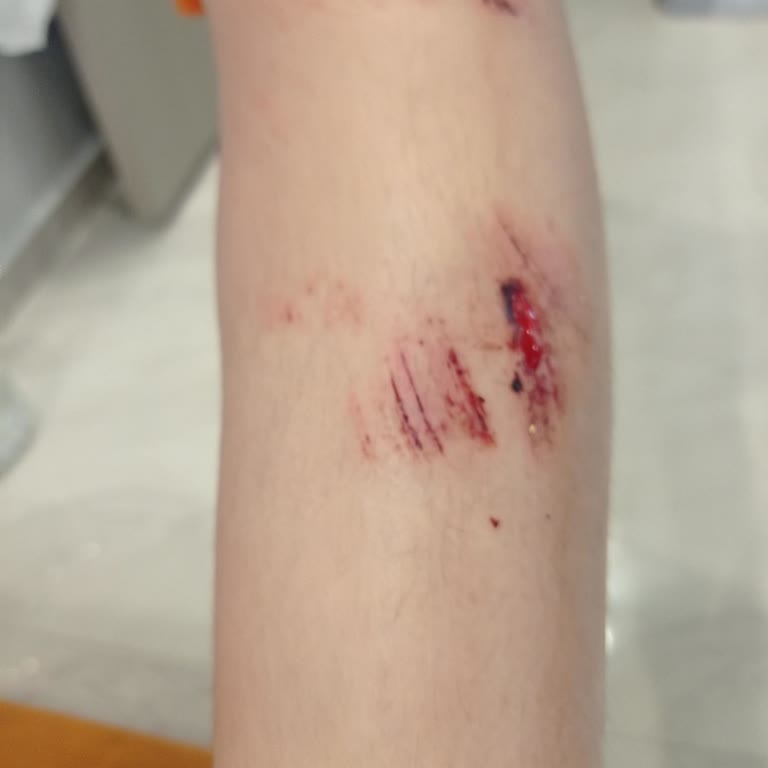 Açık Logar Kapağı Nedeniyle Yaşanan Kaza Ve Güvenlik Eksikliği