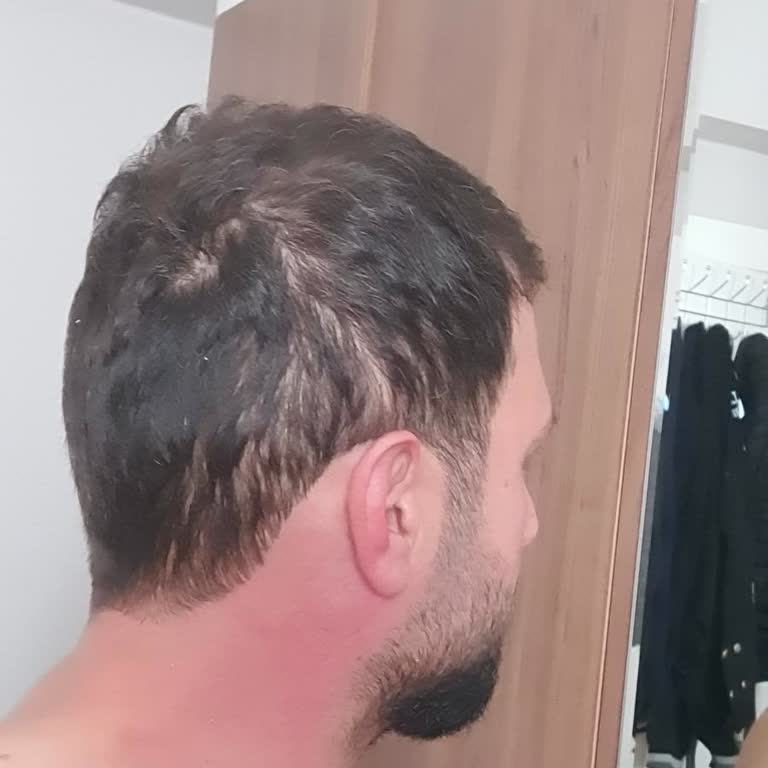 Donör Bölgesi Hasarı Ve Başarısız Saç Ekimi Sonrası Hayal Kırıklığı