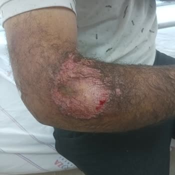 SGK İş Kazası Rapor Ücretimin Ödenmemesi Ve Yanlış Vaka Türü Kaydı