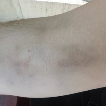 Ankara Etlik Şehir Hastanesi Kan Bağışı Sonrası Geçmeyen Morluk Ve İlgisiz Yaklaşım