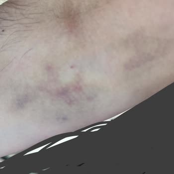 Ankara Etlik Şehir Hastanesi Kan Bağışı Sonrası Geçmeyen Morluk Ve İlgisiz Yaklaşım