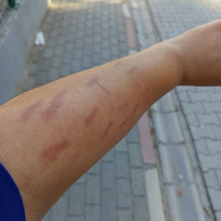 Lazer Cihazı Kullanımı Sonrası Yanık Ve İade Sorunu