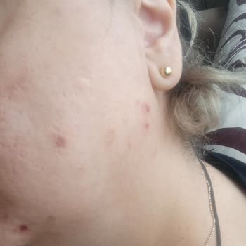 Aldığım Ürün Yüzümde Şiddetli Sivilceye Sebep Oldu, İade Talep Ediyorum