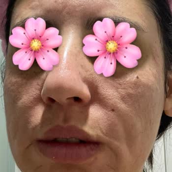 Ciltte Şiddetli Reaksiyon Ve Kızarıklık Yapan Peeling Serum