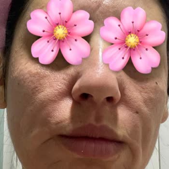 Ciltte Şiddetli Reaksiyon Ve Kızarıklık Yapan Peeling Serum