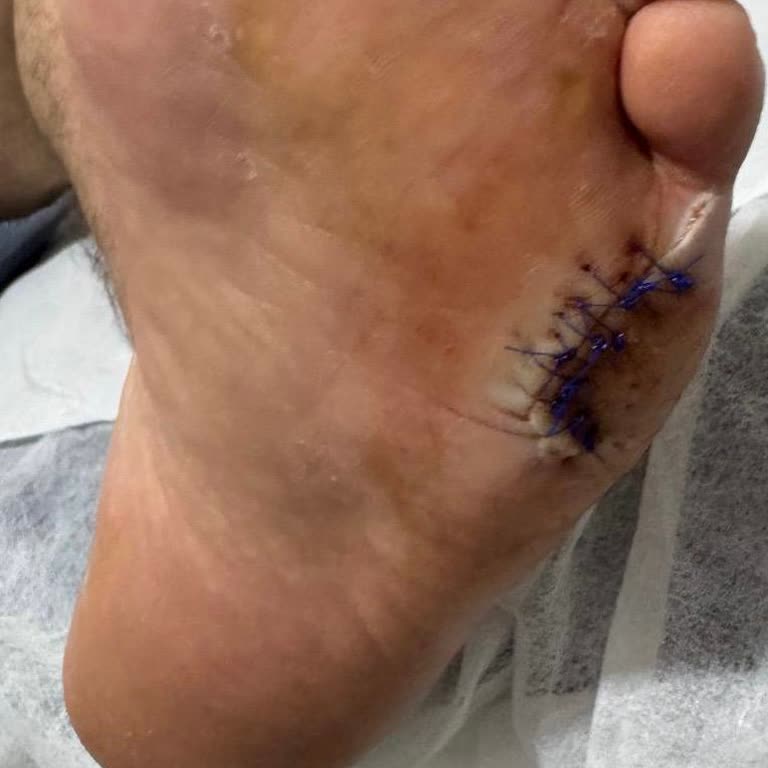 Havuzda Kırık Fayans Nedeniyle Ciddi Yaralanma Ve Destek Eksikliği