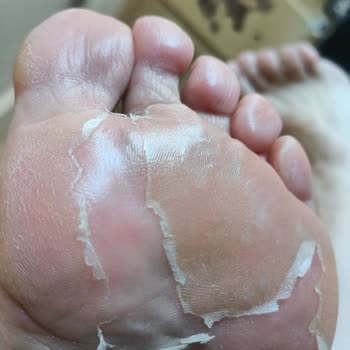 Yeni Aldığım Ayakkabıda Ciddi Rahatsızlık Ve Su Toplaması Sorunu