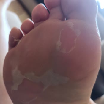 Yeni Aldığım Ayakkabıda Ciddi Rahatsızlık Ve Su Toplaması Sorunu