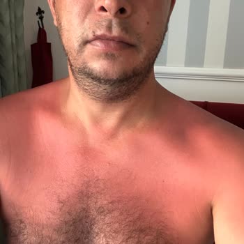 Trendyol'dan Alınan Güneş Kremi Cildimizde Yanıklara Sebep Oldu