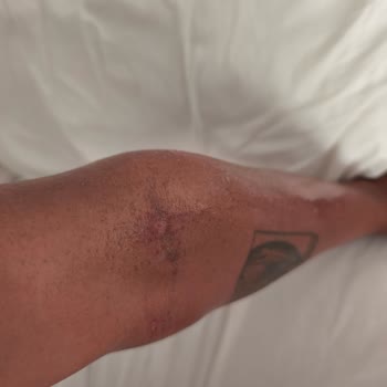 Veet Tüy Dökücü Krem Cildimi Tahriş Etti, Paramı Geri İstiyorum!